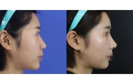 코수술(매부리 / 콧대-실리콘, 코끝-비중격,귀연골) 수술 후 3개월