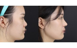 코수술(연장,콧볼축소 / 콧대-실리콘, 코끝-비중격,귀연골) 수술 후 1개월