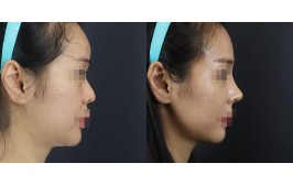 코수술(휜코 / 콧대-실리콘, 코끝-비중격,귀연골) 2주차
