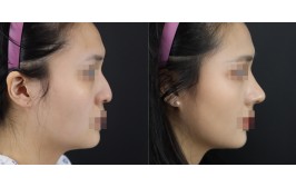 무보형물 코수술(매부리,휜코,코끝교정 / 콧대-X, 코끝-귀연골,비중격) 2주차