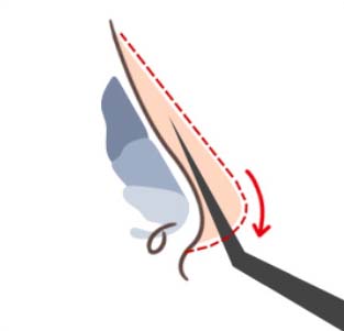 STEP 02 - 코 뼈 바로 위 보형물이 삽입될 공간을 확보