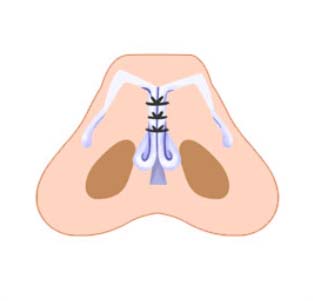 STEP 02 - 코끝의 날개 연골이 벌어진 경우 연골을 작게 다듬은 후 양쪽을 봉합하여 묶어줌