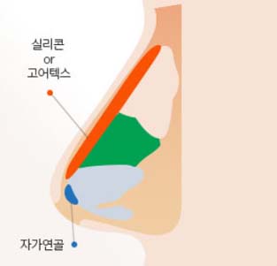 STEP 02 - 낮아지고 평평해진 콧대위에 실리콘 및 자가조직으로 콧대를 높일 수 있습니다.