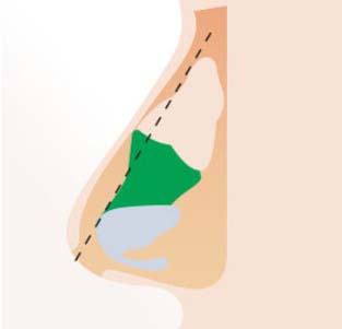 STEP 01 - 매부리를 제거한 후에 외측 절골로 뼈를 모아줍니다.