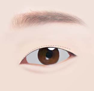 쌍꺼풀 수술 - 얇고 자연스러운 쌍꺼풀을 만들어 느끼하지 않게 호감을 주는 인상을 만들어 드립니다.