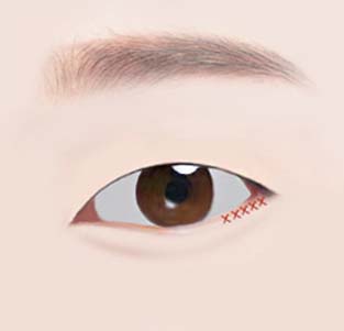 트임 수술 - 눈매, 쌍꺼풀 수술과 병행하여 시너지 효과를 만들어 드립니다.
