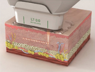 SETP 02 - 3mm 깊이의 진피층 하부 (Dermis Layer)에 열응고존 형성